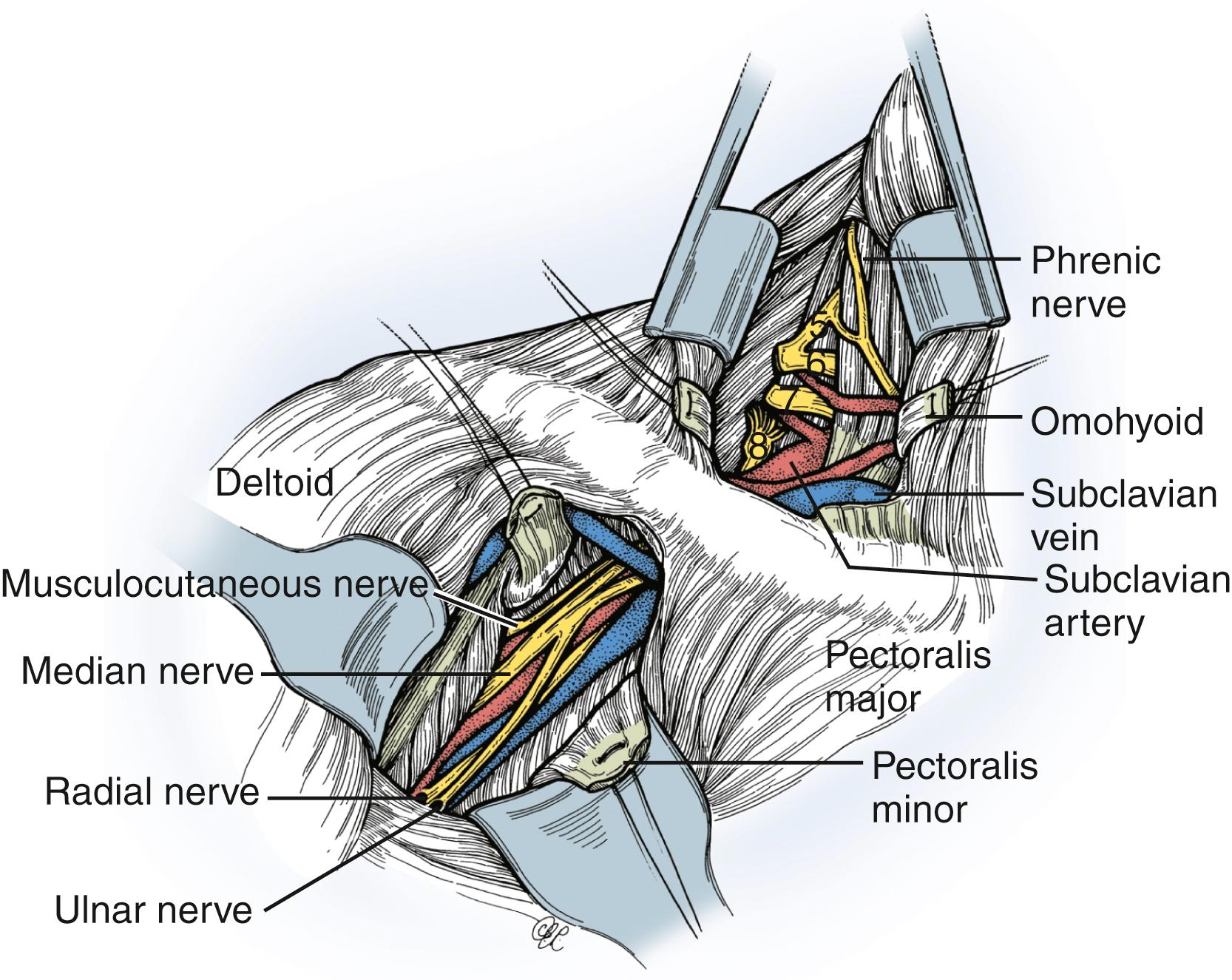 Fig. 34.9, Key anatomic landmarks include the omohyoid muscle and the pectoralis minor muscle. The supraclavicular portion of the brachial plexus lies deep to the omohyoid and the infraclavicular portion lies deep to the pectoralis minor. These muscles are divided between ligatures for later approximation. With dissection of the deltopectoral groove, the lateral cord is the most superficial structure. In this example, the upper trunk and the C7 nerve are ruptured and the C8 nerve is avulsed (note the rootlets attached to the swollen dorsal root ganglion).