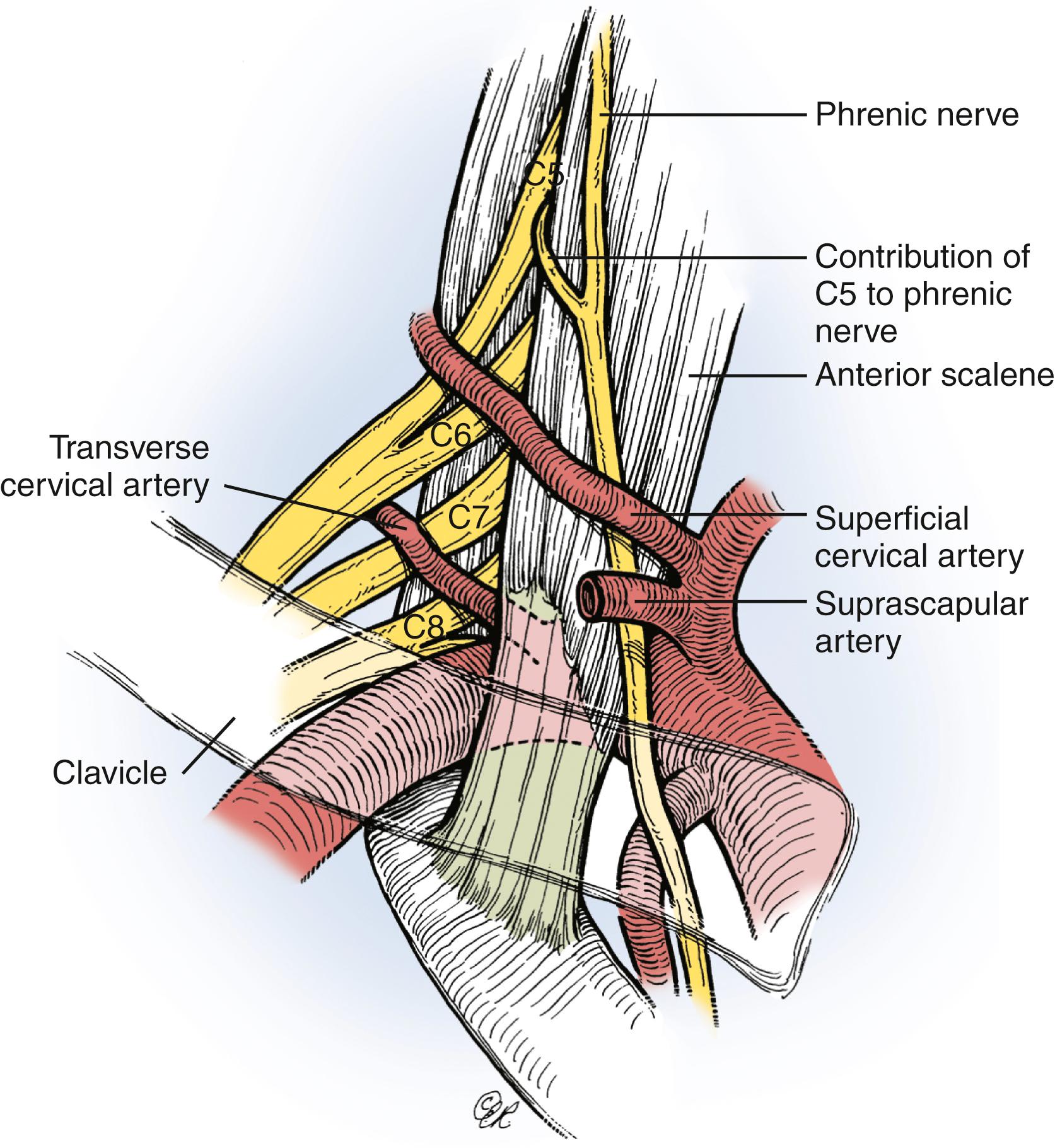 Fig. 34.10, Exposure of the supraclavicular brachial plexus. Additional landmarks helpful in identifying the various nerves include the phrenic nerve contribution from the C5 nerve and the transverse cervical (scapular) artery, which frequently crosses over the C7 nerve. The C8 nerve is located just above and posterior to the subclavian artery, whereas the T1 nerve is almost directly posterior to the artery. Division and resection of a portion of the anterior scalene muscle are necessary to obtain proximal exposure of the spinal nerves.