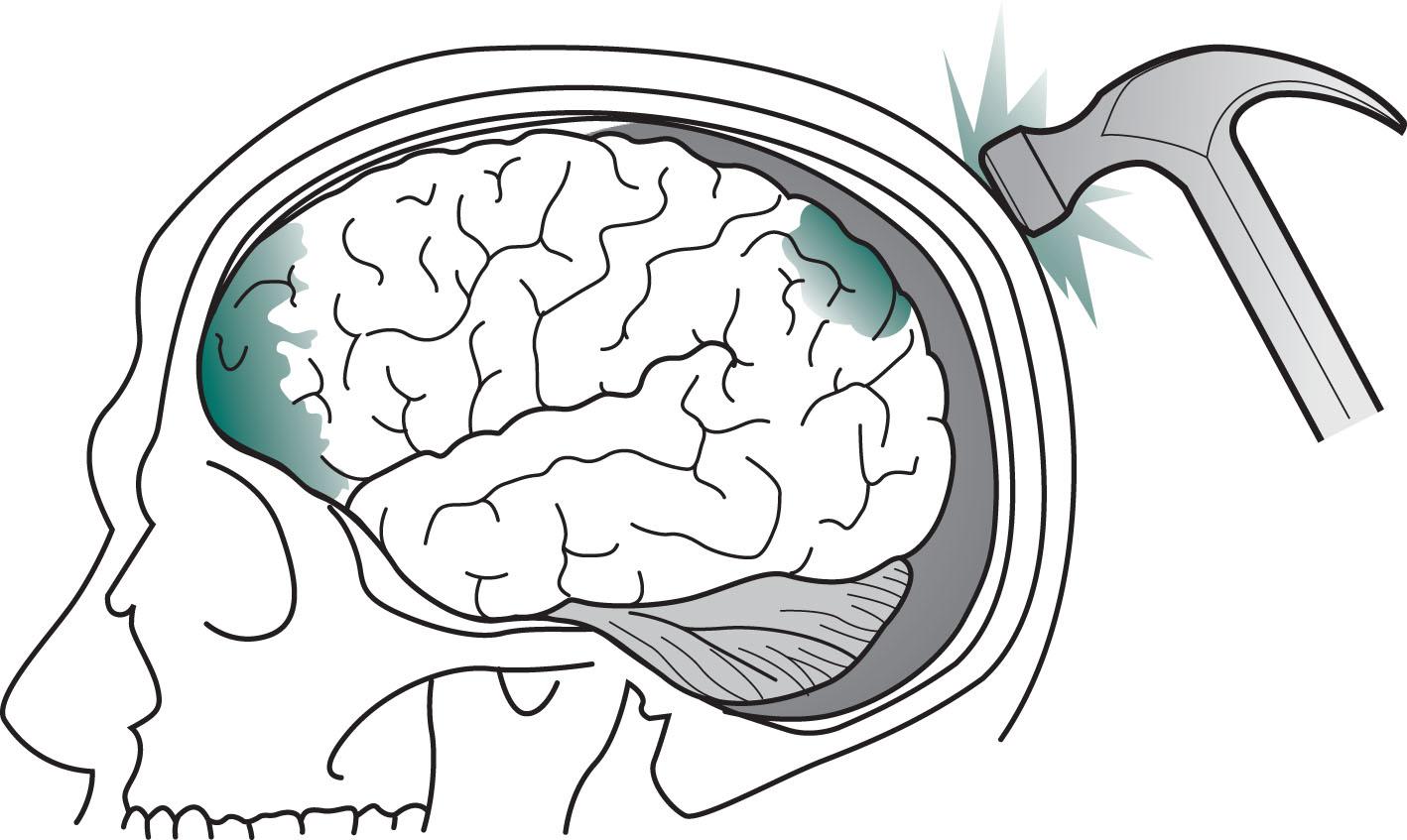 Fig. 22.1, In this drawing, a hammer blow to the back of the head inflicts a coup injury to the occipital region and, as is typical, a more extensive contrecoup injury to the inferior surface of the frontal and anterior tips of the temporal lobes.