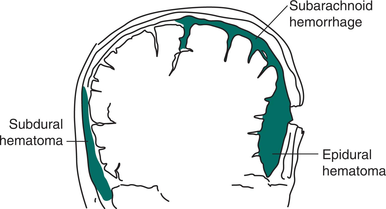 Fig. 22.2, Meningeal arterial bleeding, which usually results from a blow forceful enough to fracture the skull, causes an epidural hematoma . In contrast, venous bleeding, usually slower and under less pressure, causes subdural hematoma . Ruptured aneurysms and head trauma often cause subarachnoid hemorrhage (SAH) . In SAH, blood spreads within the subarachnoid space over the convexities, between the gyri, into the interhemispheric fissure, and down into the spinal canal.