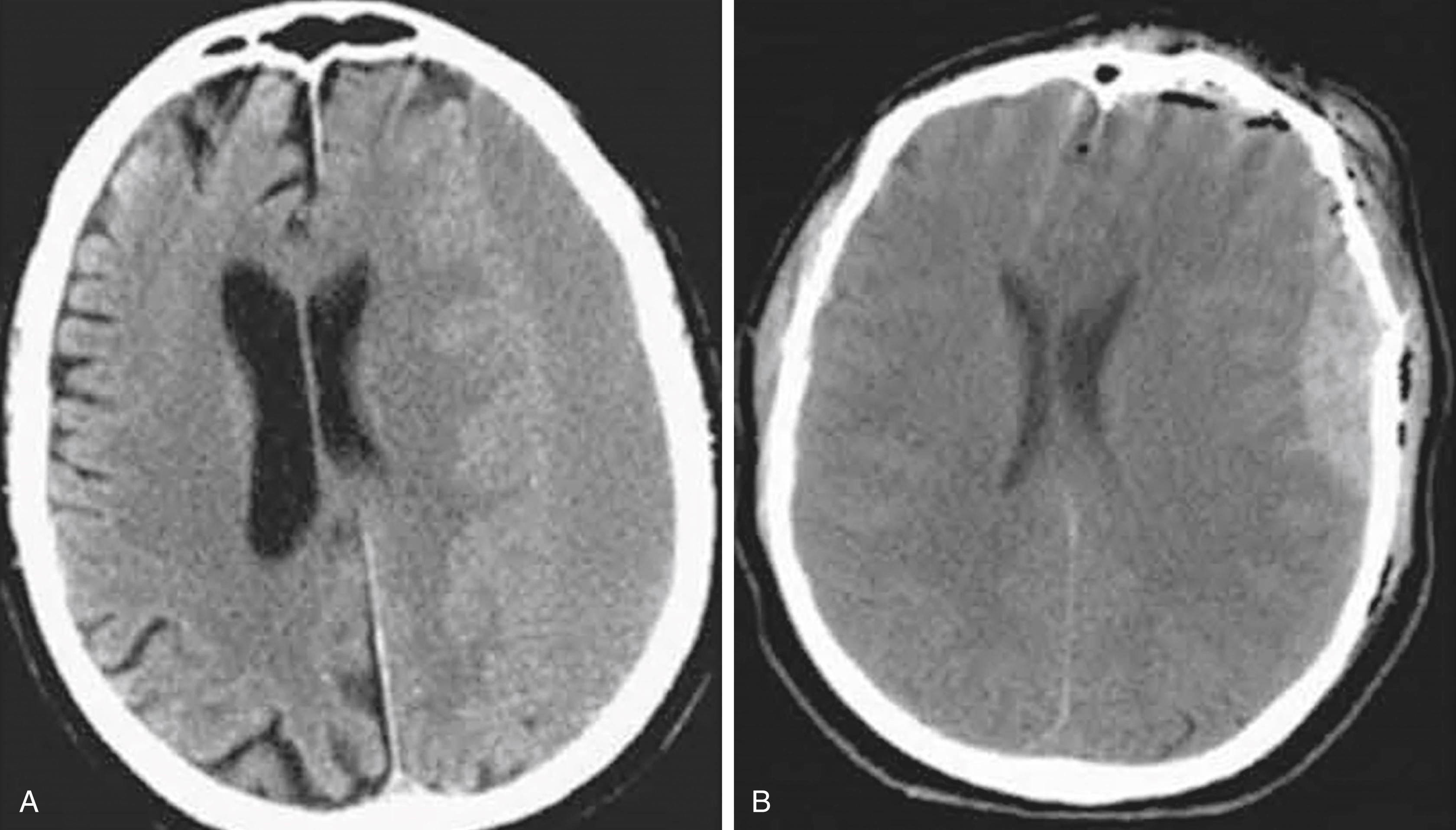 FIGURE 368-1, Computed tomography image of ( A ) subdural hematoma and ( B ) epidural hematoma.
