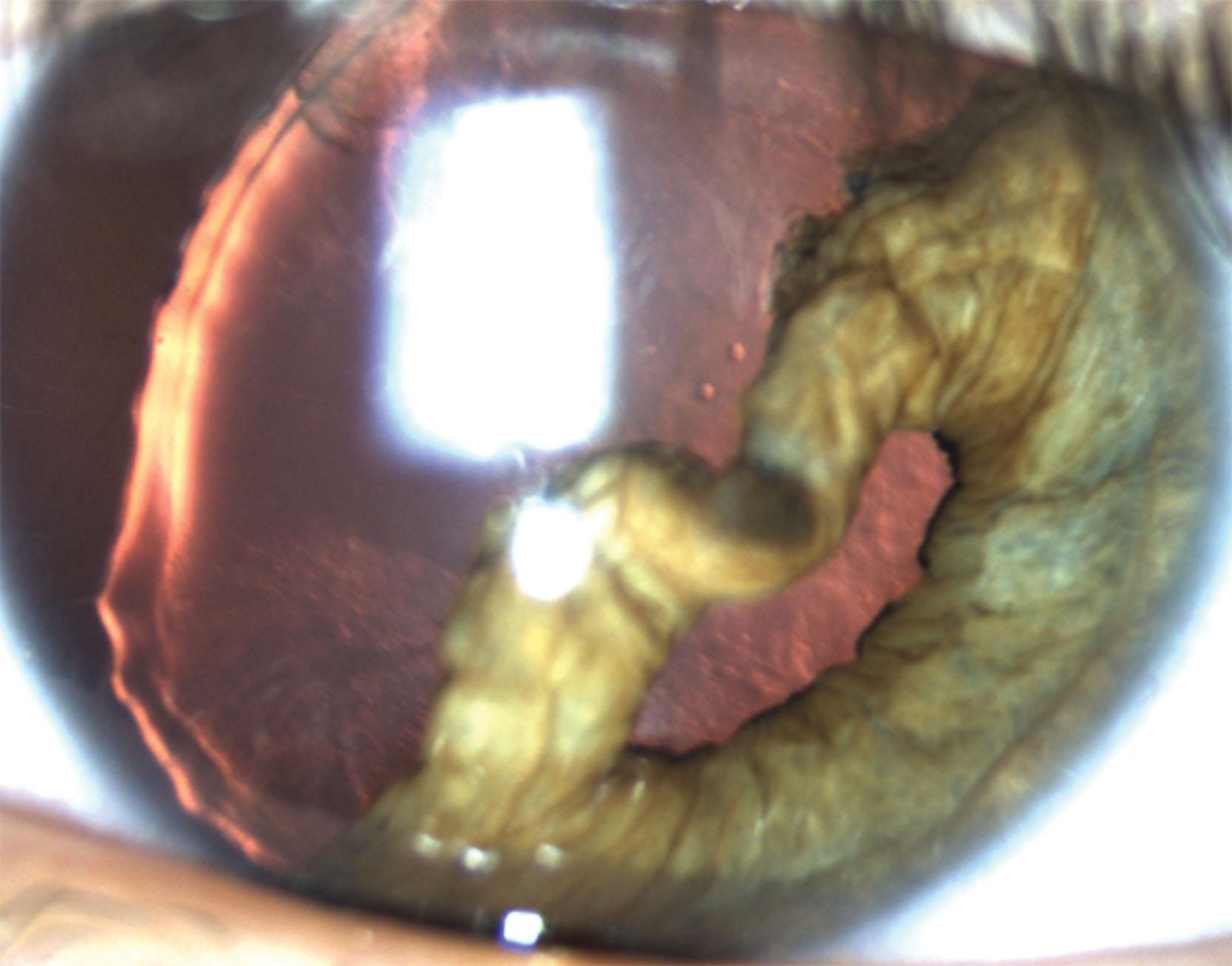 Fig 42.1, Traumatic cataract demonstrating lens opacity, zonulopathy, and a large iridodialysis. Also note the misshapen nature of the lens, confirming the younger age at which the trauma occurred.