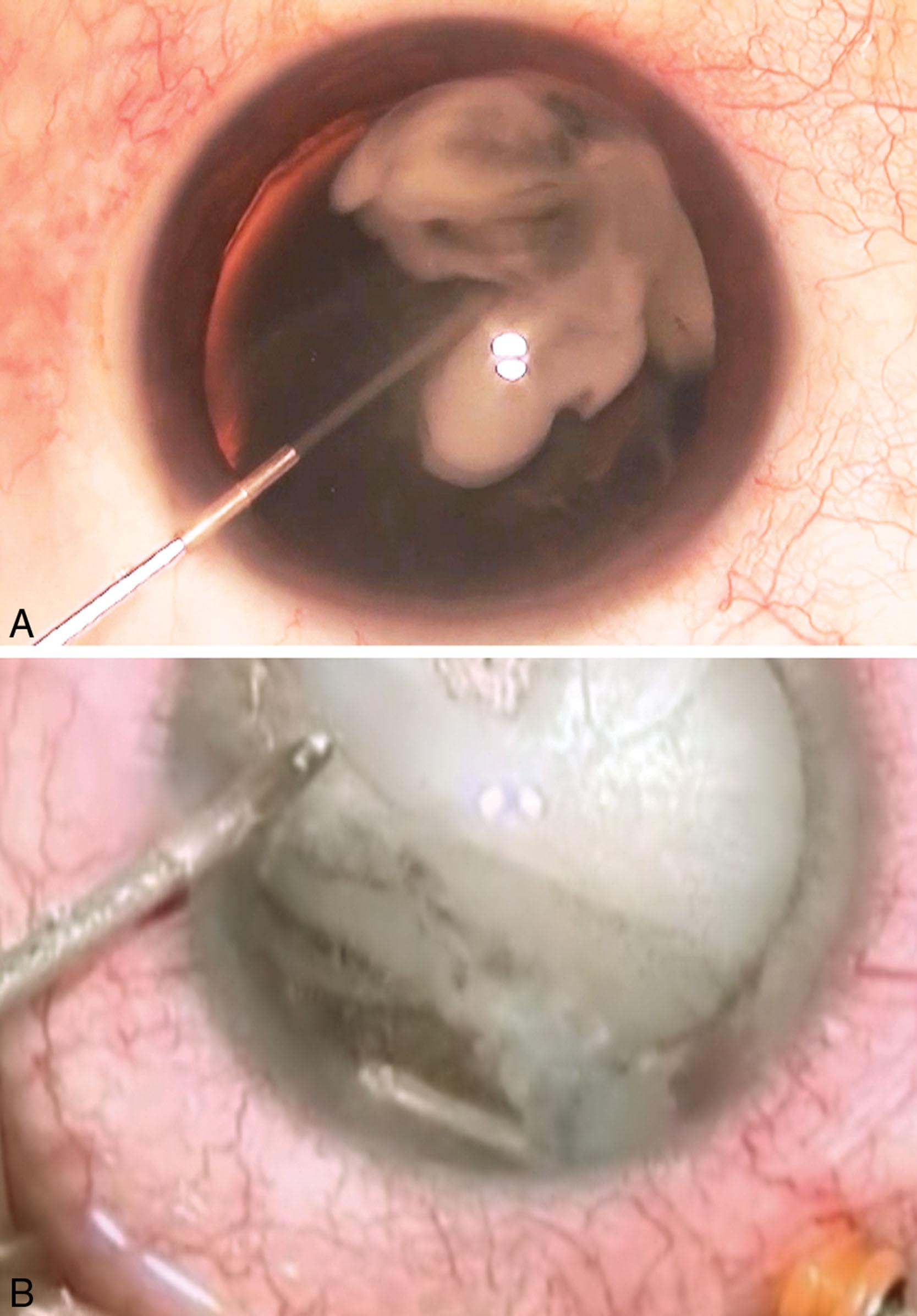 Fig. 42.2, Triamcinolone staining of vitreous prolapse seen with a stream of diluted triamcinolone entering the anterior chamber (A) and the particles suspended with vitreous gel prolapsing around the equator (B).