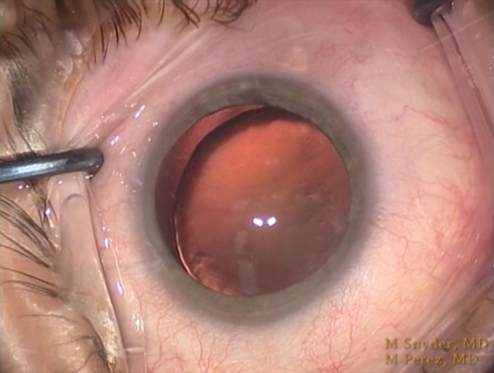 Fig. 42.4, Subluxated traumatic cataract with the equatorial edge visible through the dilated pupil and mild subluxation of the lens. The zonulopathy may have been missed without a full dilation.