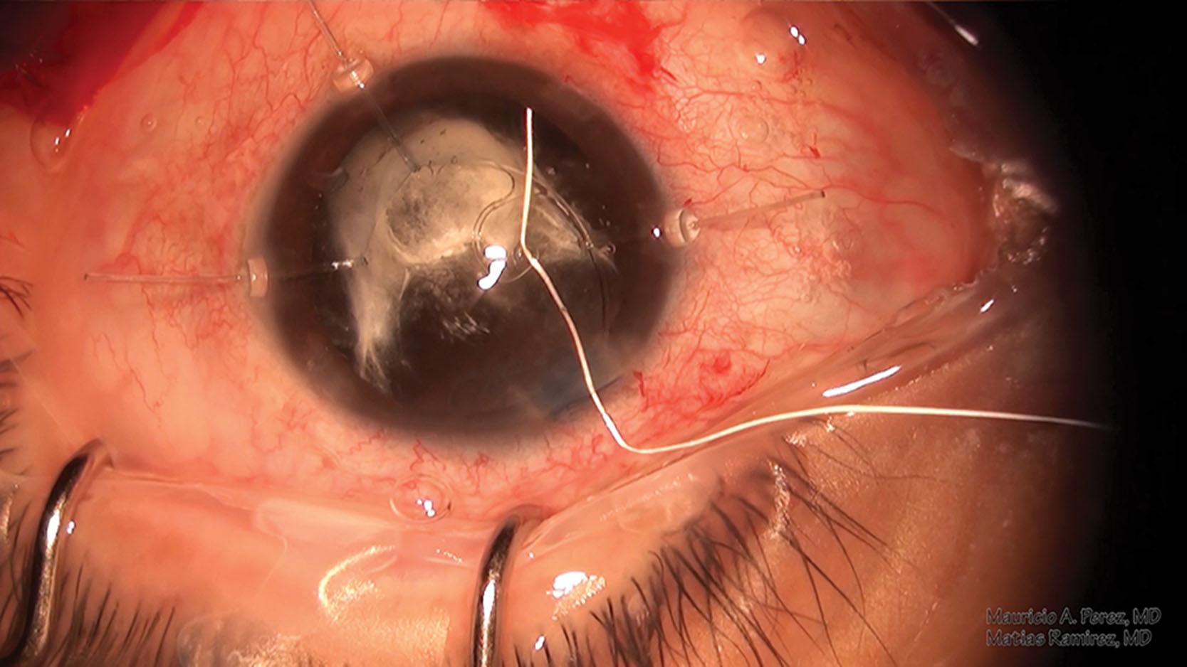 Fig. 42.5, Capsular tension segment threaded with ePTFE (Gore-tex) just before it is tucked into the capsule fornix.