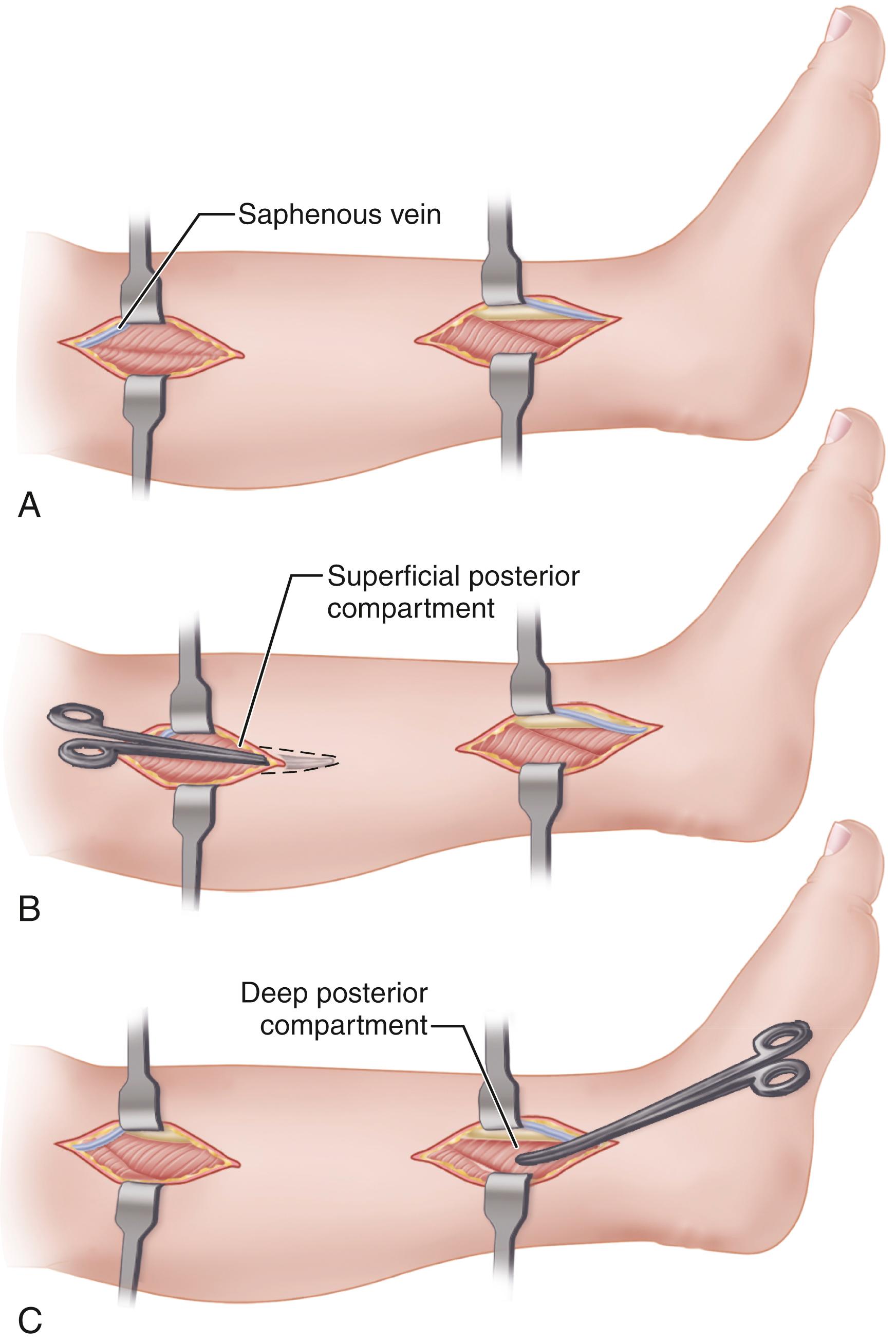 FIGURE 48.13, Rorabek two-incision release of chronic deep posterior compartment syndrome. A, Two vertical incisions; saphenous vein is identified and retracted anteriorly. B, Superficial compartment is entered and released. C, Deep fascia is incised, and deep posterior compartment is released. SEE TECHNIQUE 48.6 .