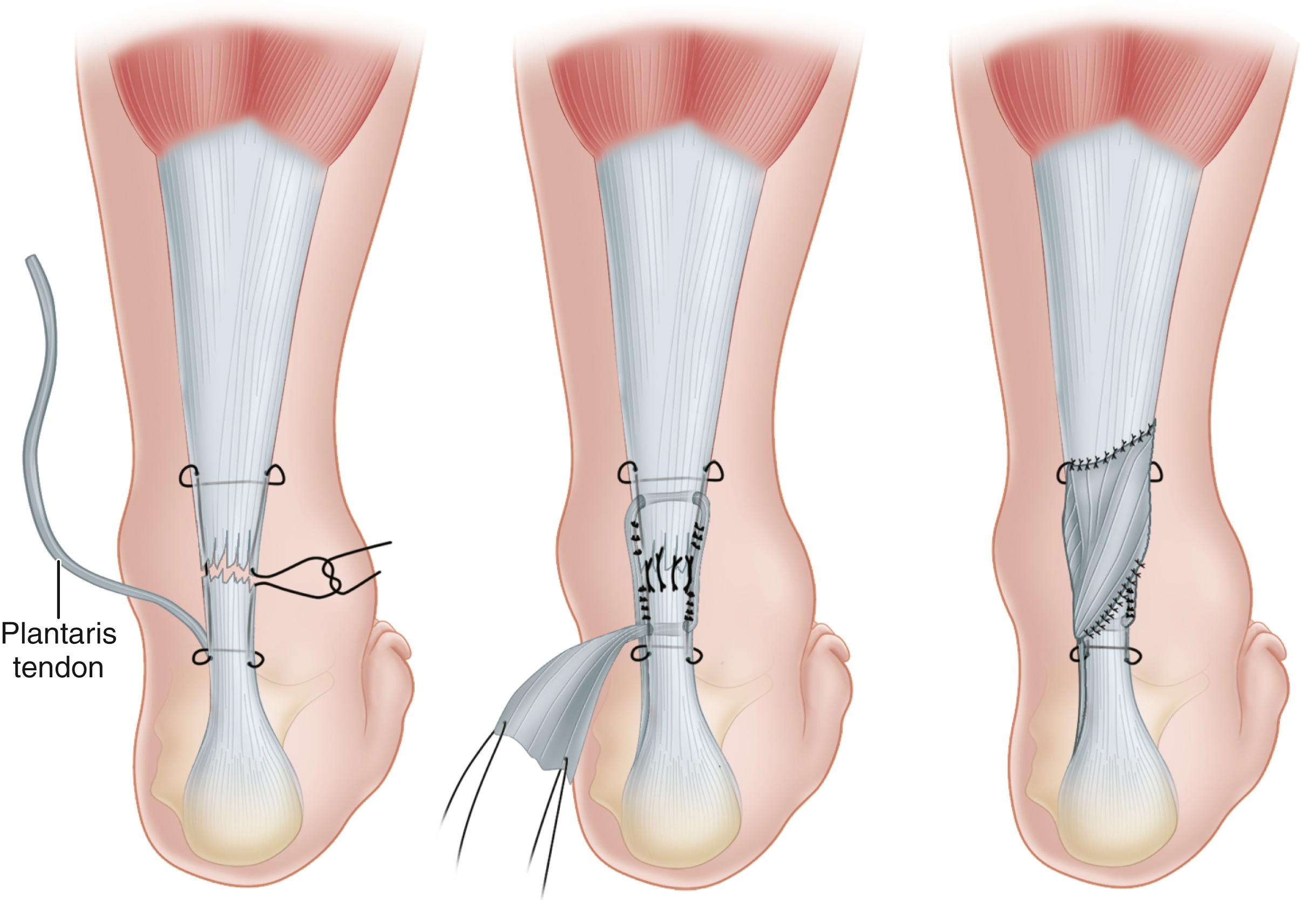 FIGURE 48.15, Technique of repair of Achilles tendon. SEE TECHNIQUE 48.7 .