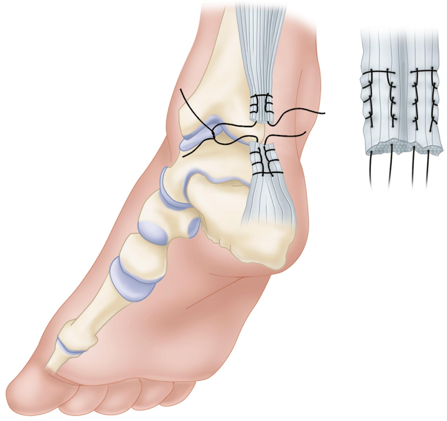 FIGURE 48.16, Krackow suture technique for Achilles tendon rupture. SEE TECHNIQUE 48.8 .