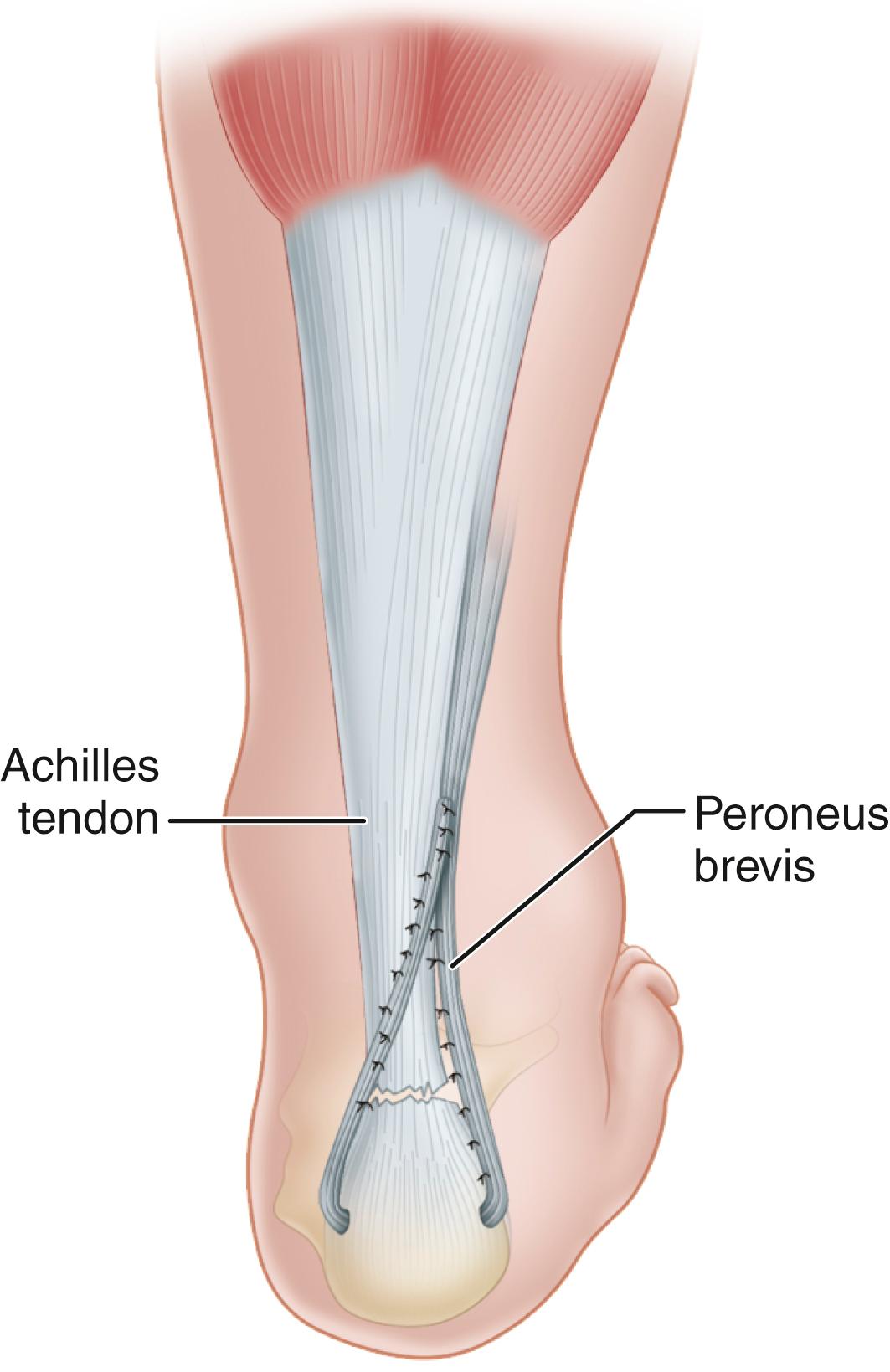 FIGURE 48.19, Dynamic loop suture of peroneus brevis to itself when end-to-end suture is not possible. SEE TECHNIQUE 48.11 .