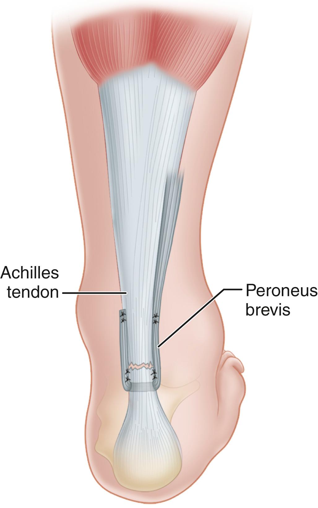 FIGURE 48.20, Turco and Spinella modification. Peroneus brevis is passed through midcoronal slit in distal stump of Achilles tendon and sutured to stump and to tendon. SEE TECHNIQUE 48.11 .