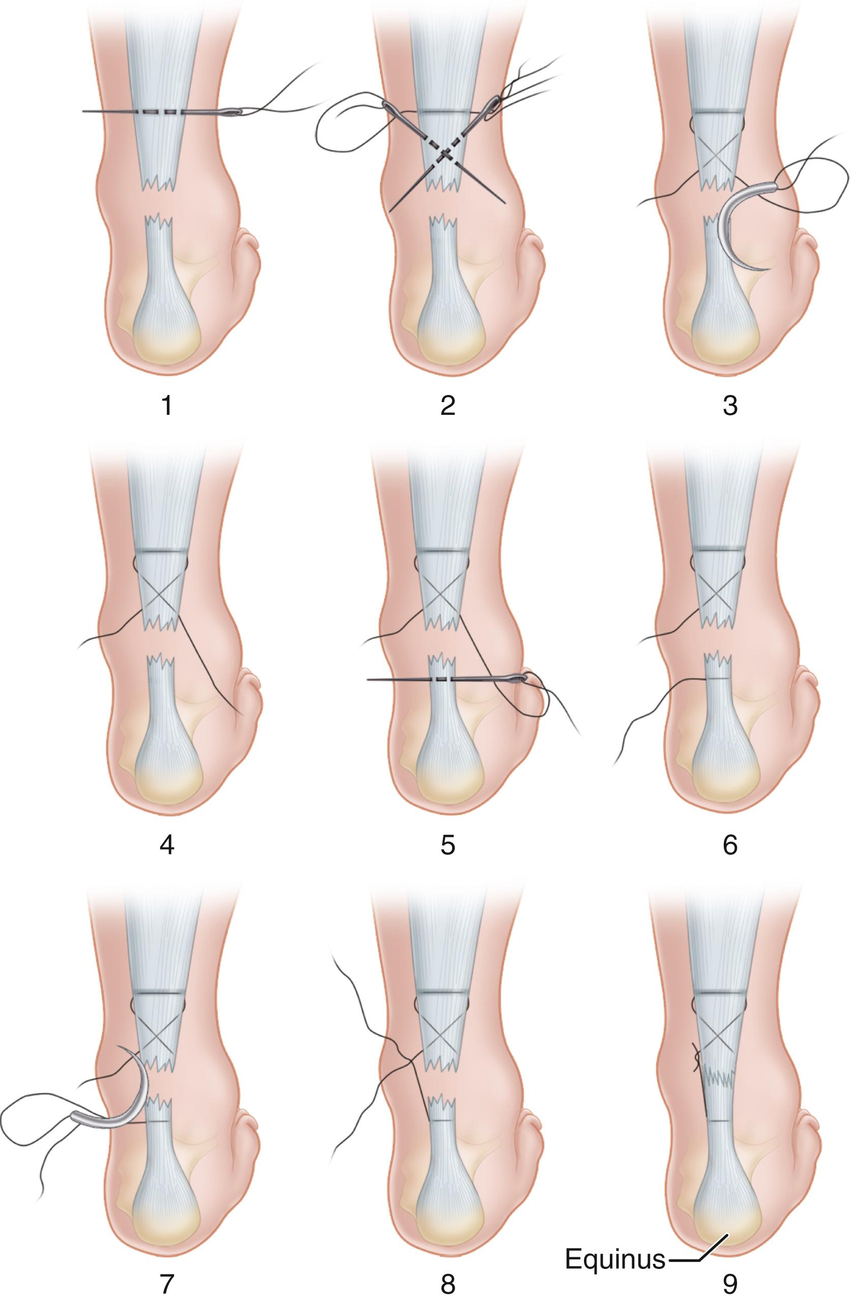 FIGURE 48.21, Ma and Griffith technique for percutaneous repair of acute rupture of Achilles tendon. SEE TECHNIQUE 48.12 .