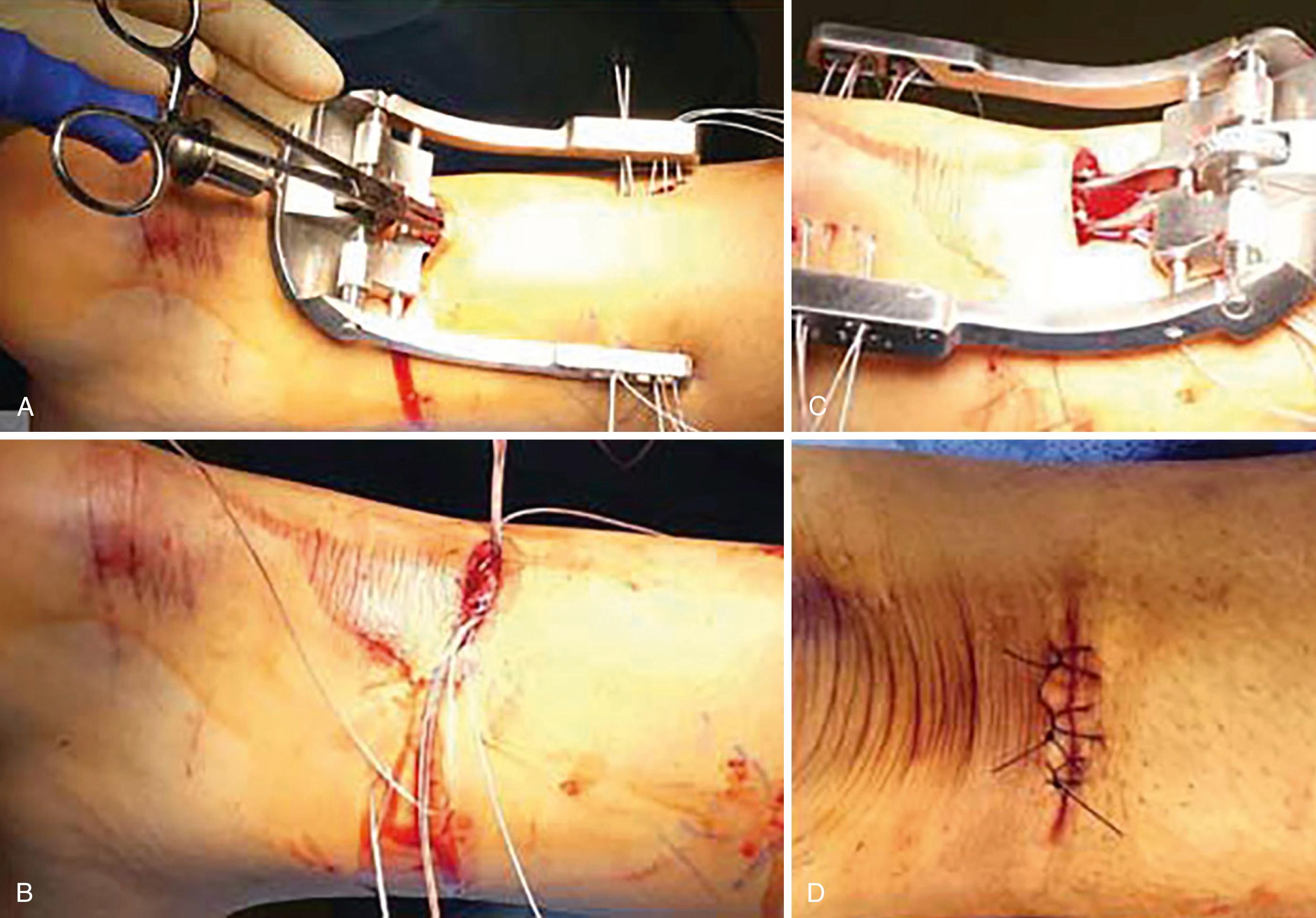 FIGURE 48.22, A, Proximal jig insertion. B, Passage of sutures creating locking sutures in either side of the tendon. C, Distal jig insertion. D, Completed repair.