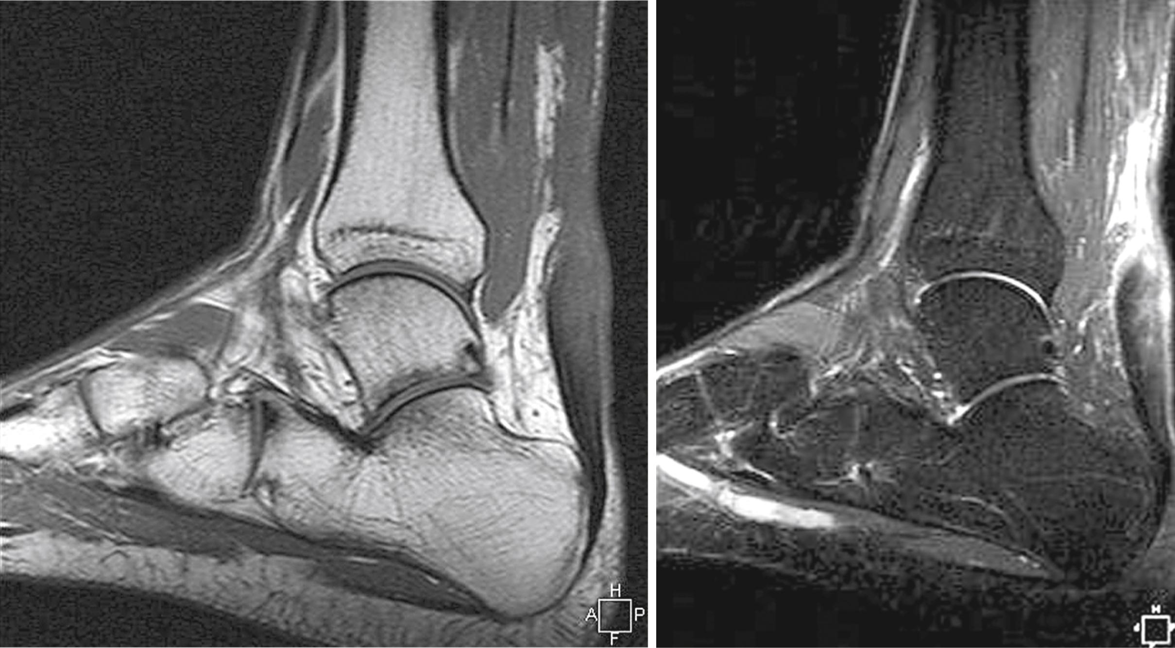 FIGURE 48.23, MRI appearance of chronic Achilles tendon rupture.