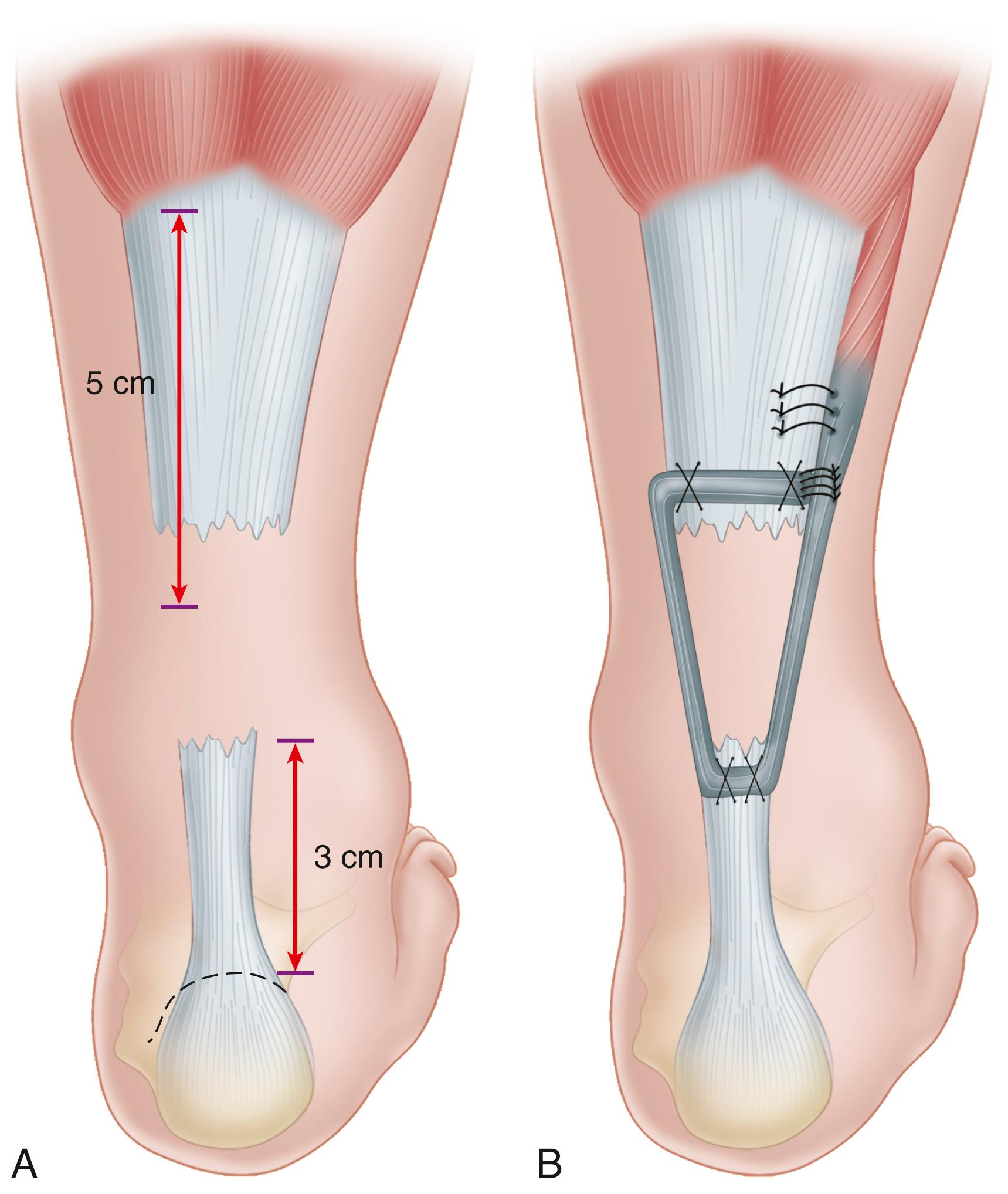 FIGURE 48.24, Peroneus brevis transfer for chronic Achilles tendon rupture. A, Longitudinal incisions. B, Completed transfer. SEE TECHNIQUE 48.14 .