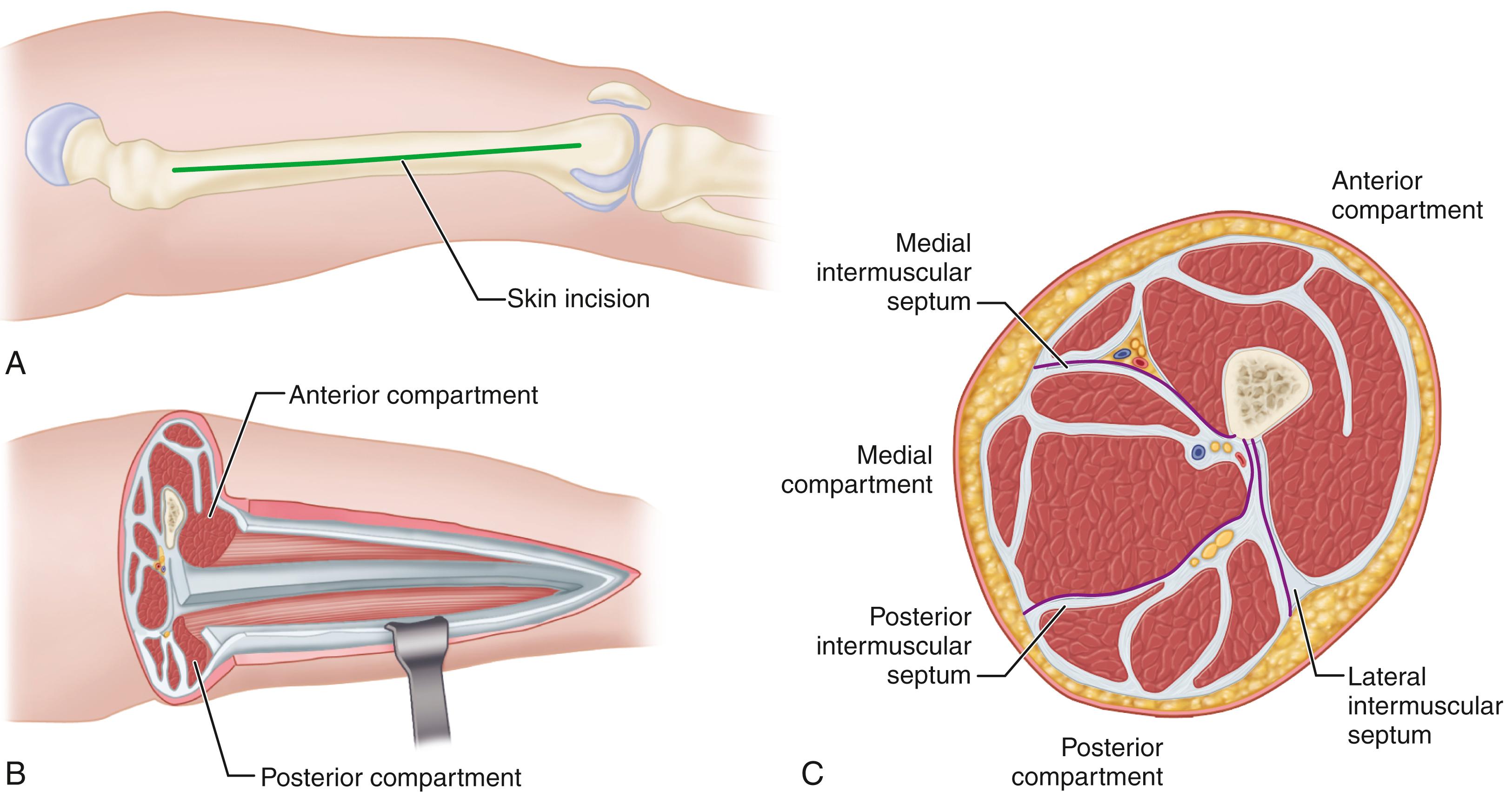 FIGURE 48.6, Decompression of thigh compartments. A, Incision from intertrochanteric line to lateral epicondyle. B, Anterior compartment is opened by incising fascia lata, and vastus lateralis is retracted medially to expose lateral intermuscular septum, which is then incised to decompress posterior compartment. C, Drawing of thigh compartments and appropriate incisions. SEE TECHNIQUE 48.1 .