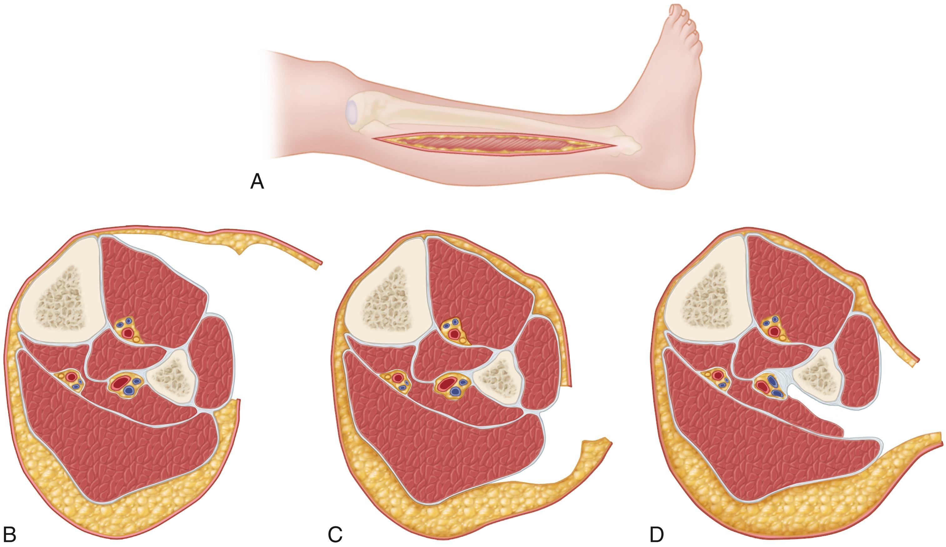 FIGURE 48.7, Technique of Davey et al. for decompression of leg compartments. A, Lateral skin incision from fibular neck to 3 to 4 cm proximal to lateral malleolus. B, Skin is undermined anteriorly, and fasciotomy of anterior and lateral compartments is performed. C, Skin is undermined posteriorly, and fasciotomy of superficial posterior compartment is performed. D, Interval between superficial posterior and lateral compartments is developed. Flexor hallucis longus muscle is dissected subperiosteally off fibula and retracted posteromedially. Fascial attachment of tibialis posterior muscle to fibula is incised to decompress muscle. SEE TECHNIQUE 48.2 .