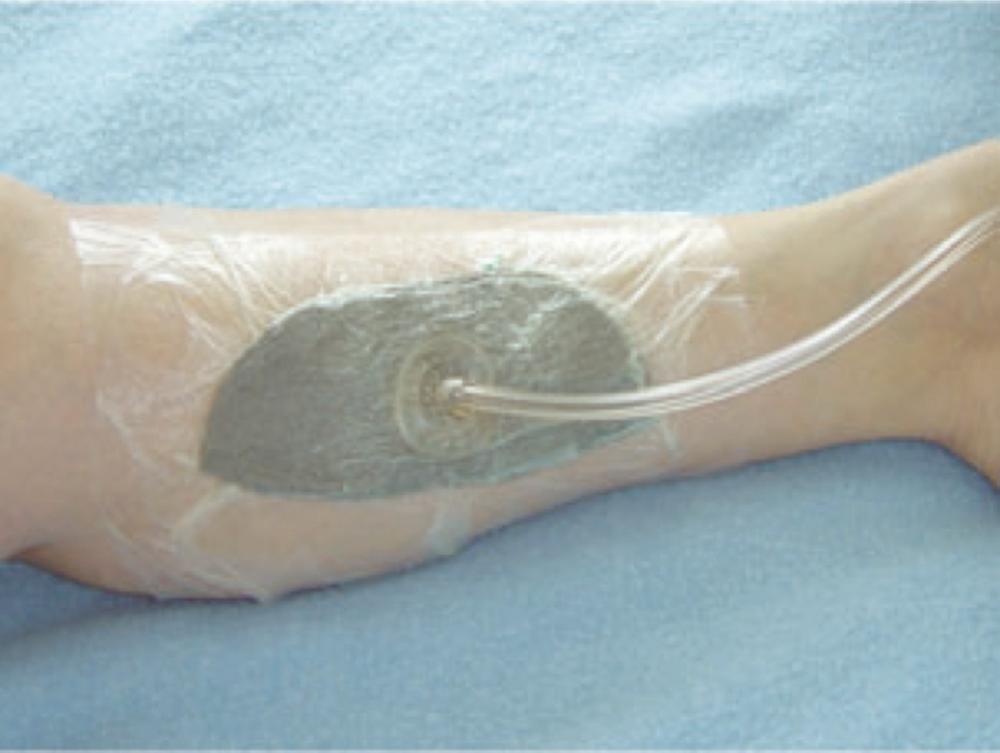 FIGURE 48.10, Fasciotomy wound with vacuum-assisted closure system in place.