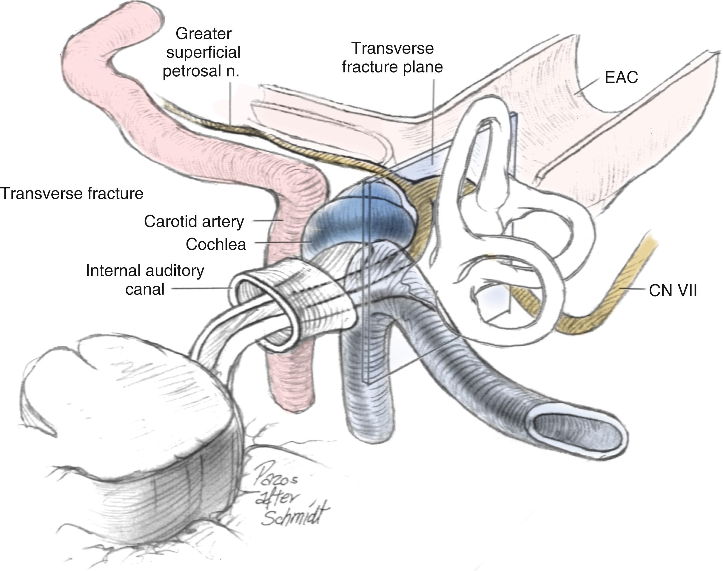 Fig. 27.6, Transverse fracture of the temporal bone. EAC , external auditory canal.
