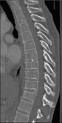 Fig. 129.1, Compression fracture.