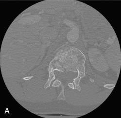 Fig. 129.2, Burst fracture.