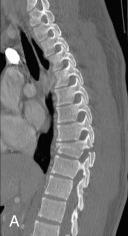 Fig. 129.3, Chance fracture.