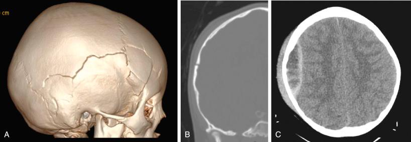 Figure 28.1, (A) 3D reconstruction of a comminuted fronto-parietal fracture. (B) A coronally-oriented portion of the fracture crosses the path of the middle meningeal artery (MMA). (C) Epidural hematoma was observed intra-operatively to originate from a laceration of the MMA.