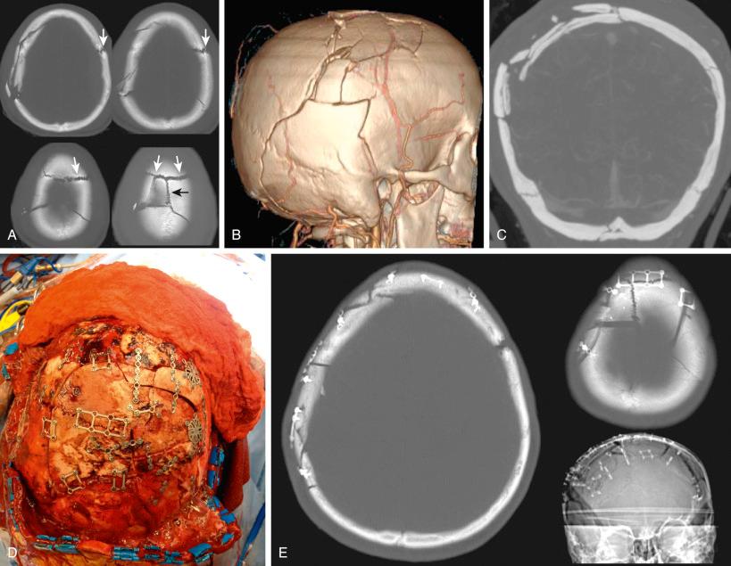 Figure 28.2, (A) Axial, (B) 3D, and (C) coronal views of an extensively comminuted skull fracture. White arrows identify diastasis of the coronal suture on multiple axial views. Black arrow identifies sagittal suture diastasis. (D) intra-operative photograph and (E) post-operative CT demonstrate improved skull contour after fracture plating.
