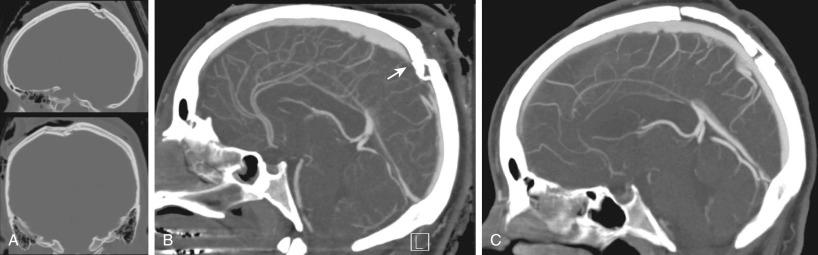 Figure 28.3, (A) Non-contrast CT imaging (bone window) demonstrating focal depressed skull fracture from blunt injury near the cranial vertex. (B) Sagittal section of CT venogram demonstrates focal reduction of flow through the superior sagittal sinus in the area immediately underlying the skull fracture. (C) Post-operative CT venogram shows restoration of flow, through the stenotic segment.