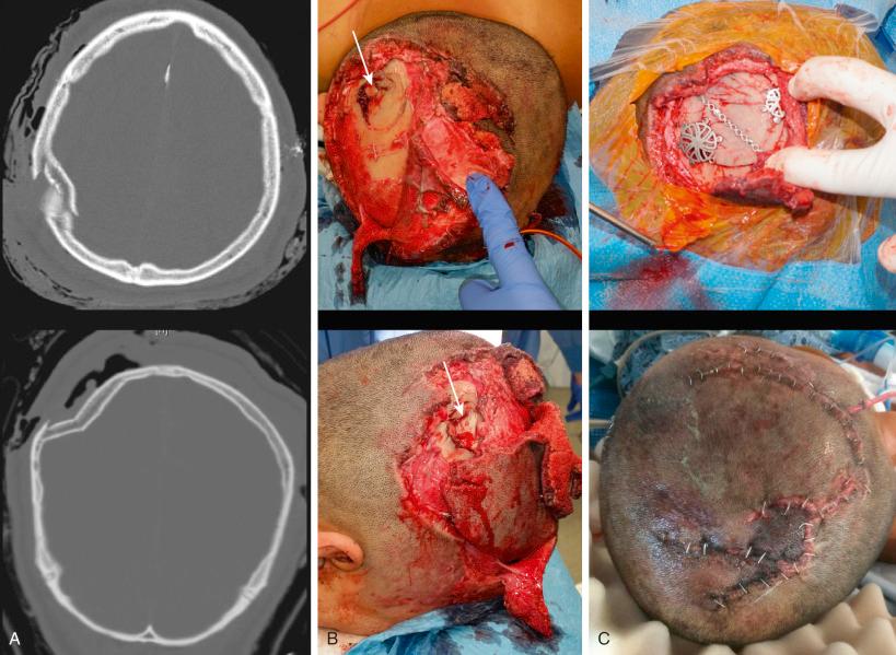 Figure 28.5, (A) Open depressed skull fracture with approximately 1.5 cm depression seen in axial and coronal cross-section. (B) Scalp degloving injury and grossly contaminated bony fracture lines underwent extensive washout and debridement (depressed fracture identified by arrow). (C) A craniotomy was performed around the fracture site, with intra-operative plating and replacement shown, as well as an image after scalp repair.