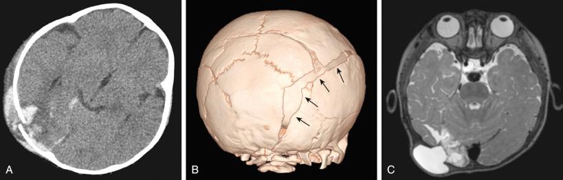 Figure 28.7, Growing skull fracture. (A) non-contrast CT obtained at the time of initial injury demonstrates traumatic brain injury as well as closed skull fracture. (B) At 9 month follow-up, 3-D CT reconstruction reveals wide separation of the fracture edge, approximately 2 cm maximal extent. The growing skull fracture extends anteriorly to the frontal bone, as well as inferiorly through the occipital bone to the foramen magnum. (C) MRI confirms CSF pooling within the fracture gap, associated with leptomeninges focally herniated through the fracture.