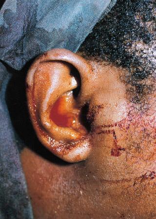 Figure 28.8, Cerebrospinal fluid leaks from the ear canal and a hematoma is visible in the postauricular area. These are signs of a fracture at the junction of the middle and posterior cranial fossa.