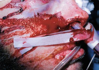 Figure 28.10, Brain and cerebrospinal fluid (CSF) leak from the nose after an extensive anterior skull base fracture. The adhesive tape on the endotracheal tube shows the “double ring” sign – a clearer bloodstainedfluid (CSF) around a darker center (blood).