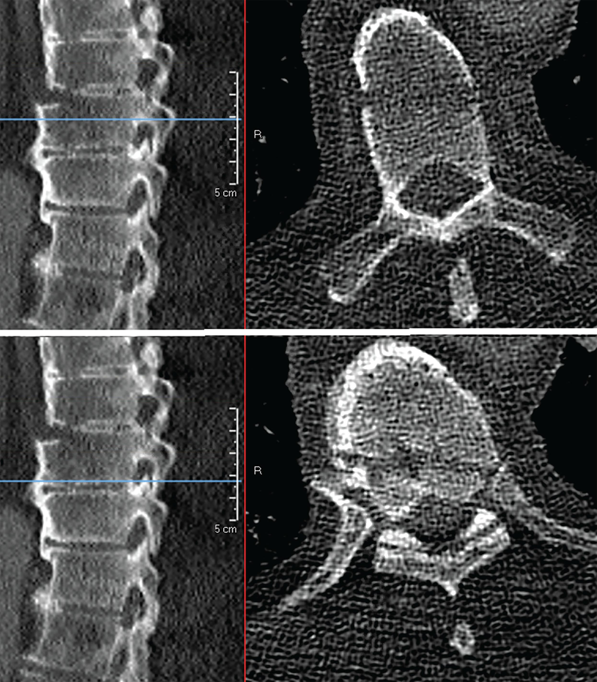 Fig. 11.1, Unstable burst fracture of the T8 vertebral body with up to 6 mm of anteropulsion and approximately 25% height loss of the anterior superior endplate