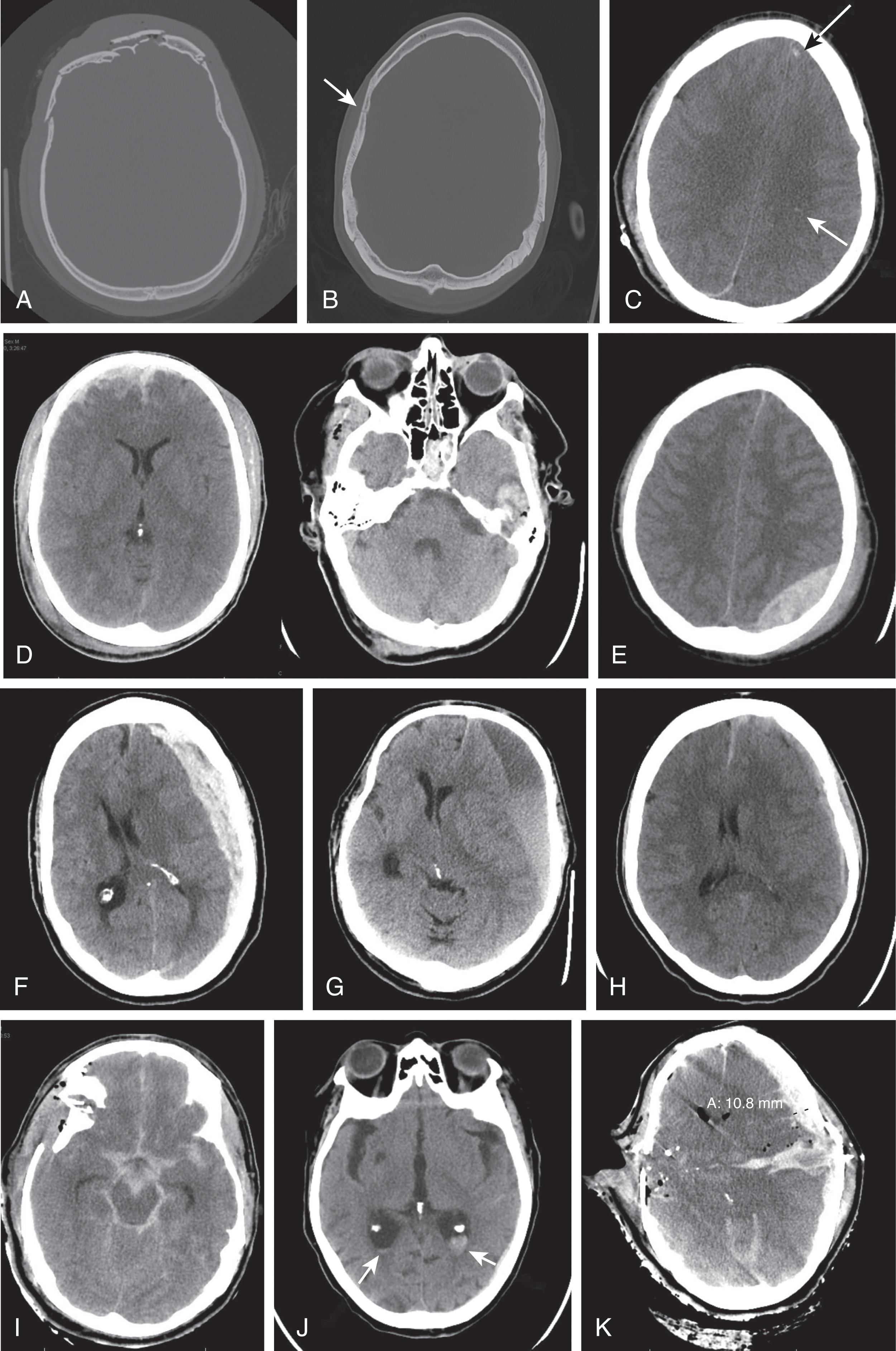 FIGURE 2, (A) Extensive fracture of the frontal bone and frontal sinus. (B) Fractures can sometimes be more subtle. (C) Diffuse axonal injury can sometimes be only represented on computed tomography by small punctate contusions due to the shearing of axons. Significant edema can be present. (D) Contusions frequently occur in the frontal and temporal regions from the brain striking the bone. (E) Epidural hematoma with typical lenticular shape. (F) Large acute subdural hemorrhage (SDH) with midline shift. Although size and extent of midline shift are important, the prognosis may still differ significantly between patients. (G) A large acute on chronic SDH in a patient with a large amount of midline shift, but due to the slower development and brain atrophy present, this patient presented only with headaches and mild weakness. This is contrasted by (H) a younger patient with a smaller SDH but with a very poor Glasgow Coma Scale on arrival. (I) Large amount of subarachnoid hemorrhage layering in the basilar cisterns. (J) Small amount of intraventricular hemorrhage layering in the ventricle. (K) Computed tomography demonstrating a penetrating injury from a gunshot wound.