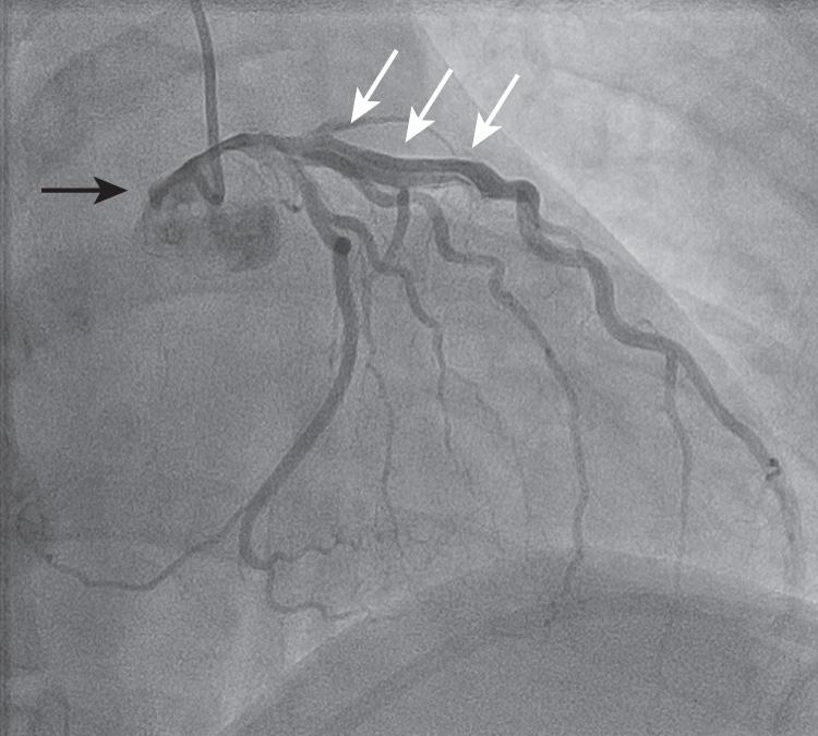 Fig. 72.2, Traumatic coronary dissection showing a double lumen in the left anterior descending artery (white arrows) , extending retrograde and narrowing the lumen of the left main coronary artery (black arrow) in a patient with a high-speed motor vehicle accident.