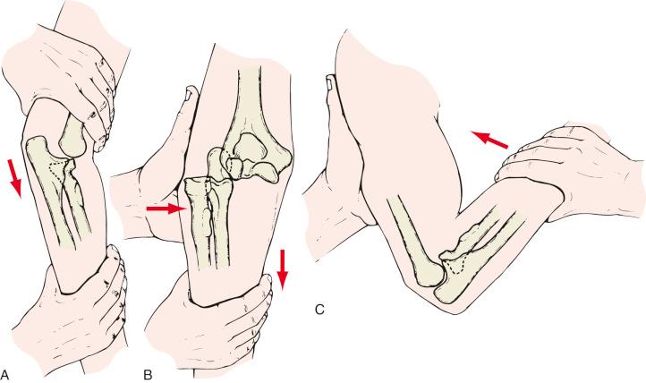 Fig. 44.1, Reduction of a posterior elbow dislocation consists of longitudinal traction (A), correction of lateral or medial displacement (B), and flexion of the elbow (C).