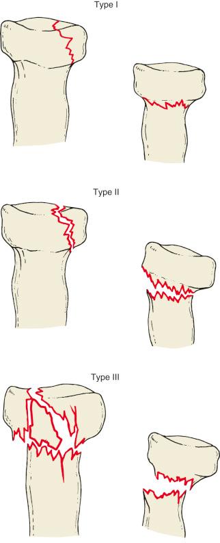 Fig. 44.2, Modified Mason classification system for radial head fractures.