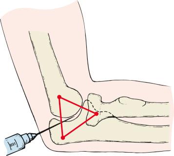 Fig. 44.3, Aspiration of the radiocapitellar joint is performed with a needle introduced through the center of a triangle formed by the radial head, the tip of the olecranon, and the lateral epicondyle.