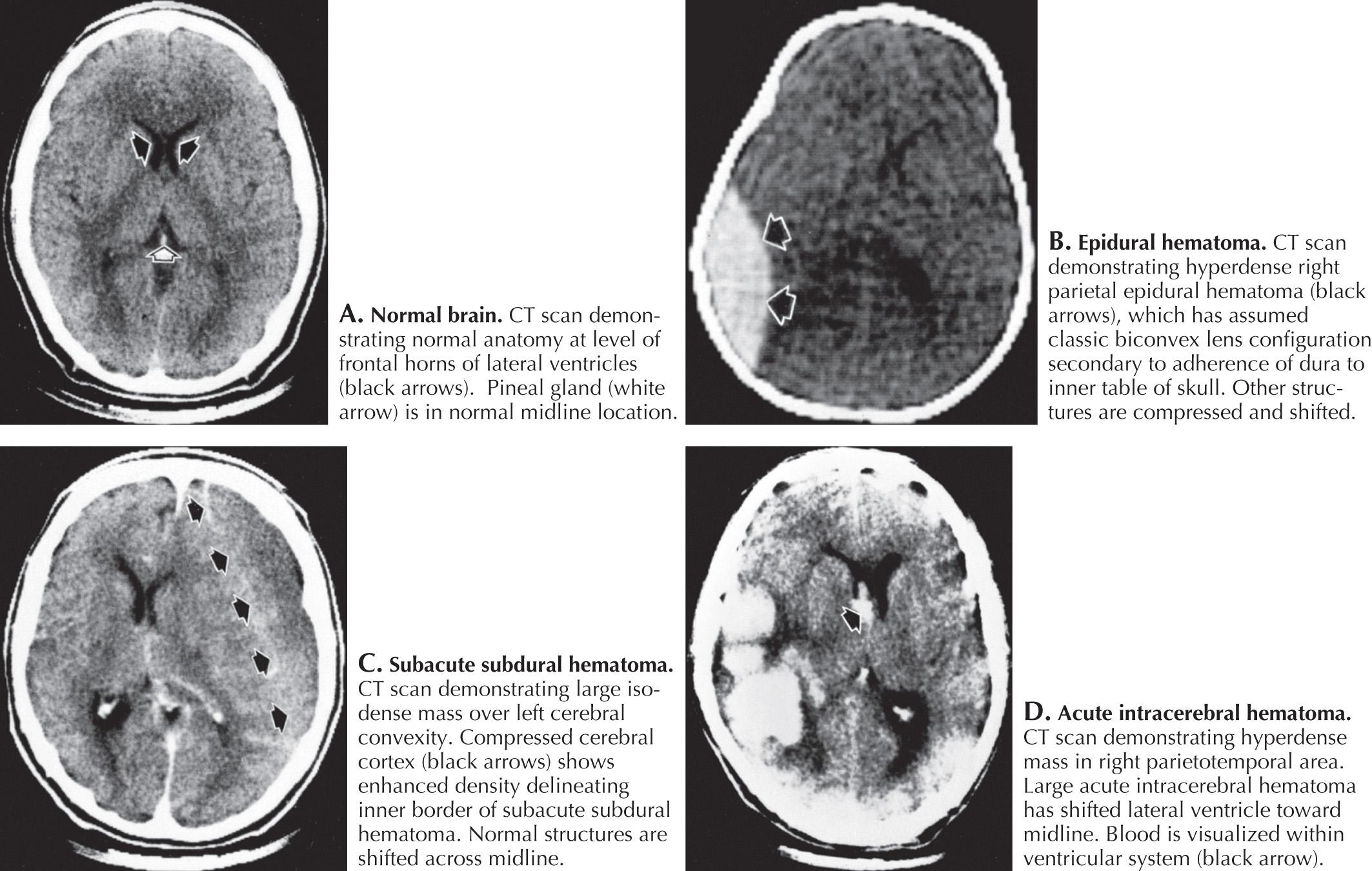 Fig. 19.7, CT and Angiogram of Intracranial Hemorrhage.