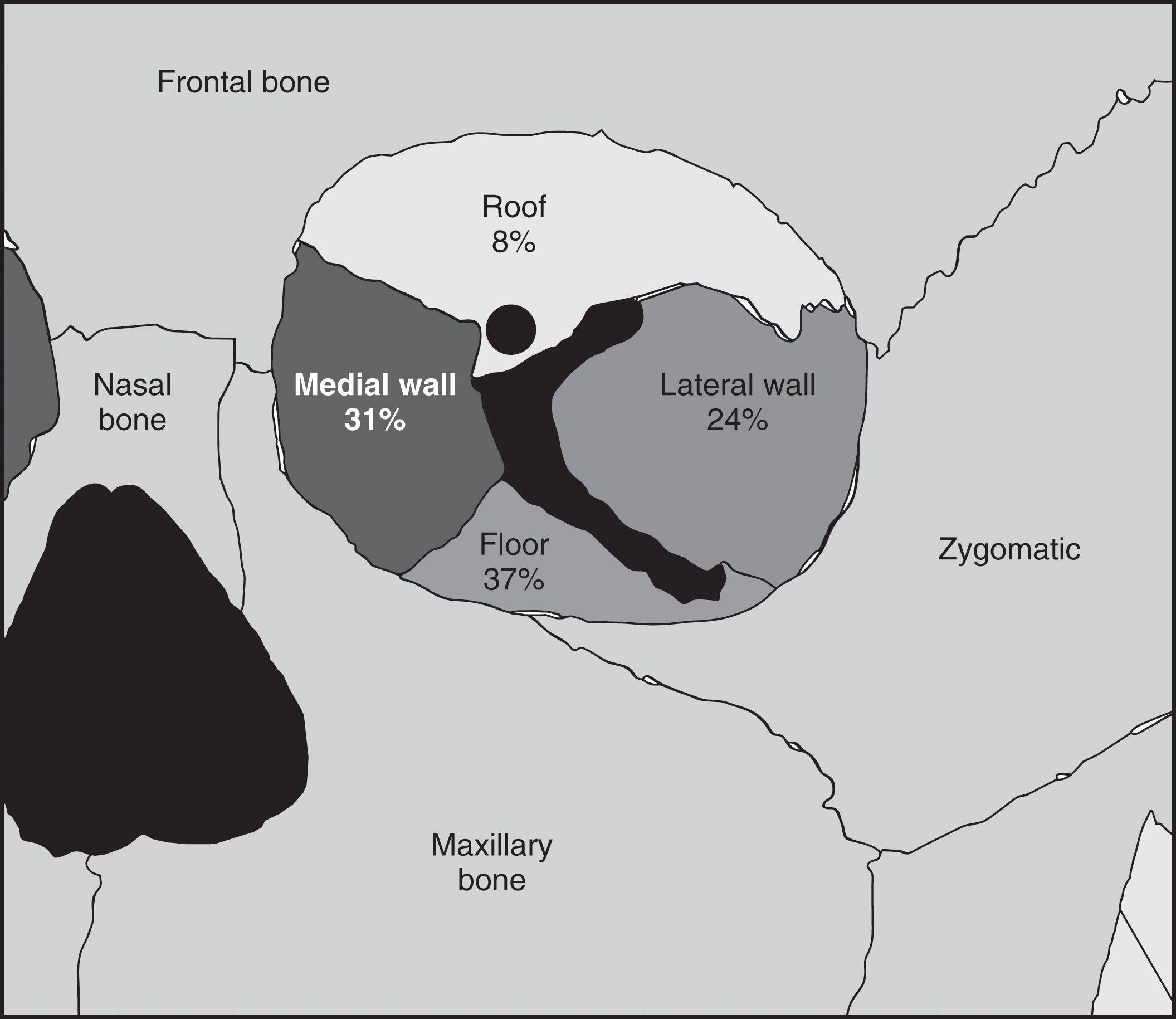 FIGURE 5, Diagram of orbital bones with incidence of orbital fractures.