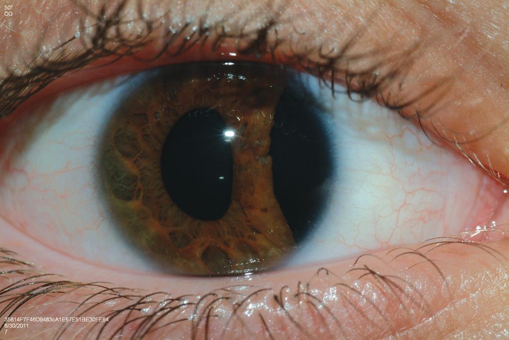 FIGURE 6, Iridodialysis in a young male after airsoft pellet gun injury to the right eye. On presentation, a dense hyphema prevented visualization of the iris.