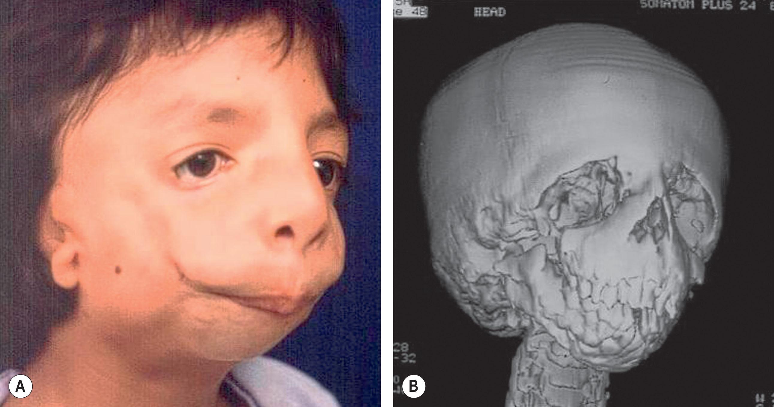 Figure 29.1, Characteristic facial features (A) and CT scan findings (B) of TCOF1-based Treacher Collins syndrome. This patient demonstrates the soft-tissue and bone malar hypoplasia, micrognathia, microtia, and coloboma of the lower eyelid with down-slanting palpebral fissures.