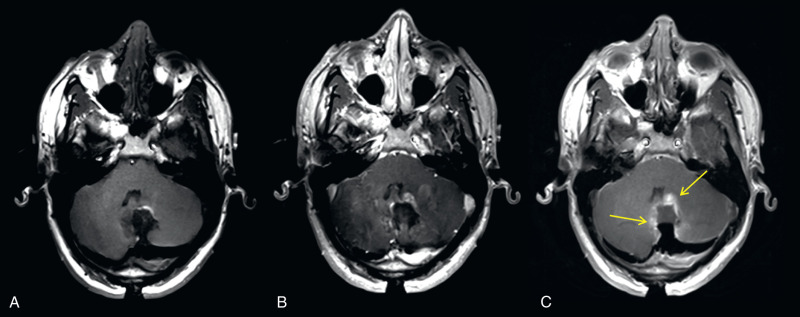 Figure 15.1, Leakage of gadolinium along surgical margins mimicking residual tumor on intraoperative MRI in a 26-year-old patient with a cerebellar mass (juvenile pilocytic astrocytoma). Precontrast T1-weighted (T1W) image (A), postcontrast T1W image obtained at 5 minutes (B), and repeat T1W image (C) without additional contrast obtained approximately 60 minutes after intravenous gadolinium contrast. Apparent enhancement can be seen on the delayed image (C; arrows ), reflecting gadolinium leakage.