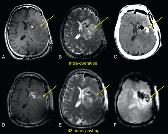 Figure 15.2, Hyperacute hemorrhage on intraoperative MRI. The left subinsular hyperacute hemorrhage (arrows) is difficult to appreciate on the intraoperative MRI (T1 hypointense and T2 hyperintense) (A and B). The hemorrhage (arrows) is better appreciated on the 48-hour postoperative T1W, T2W, and T2*-GRE images (D–F) and clearly seen on the noncontrast CT (C).