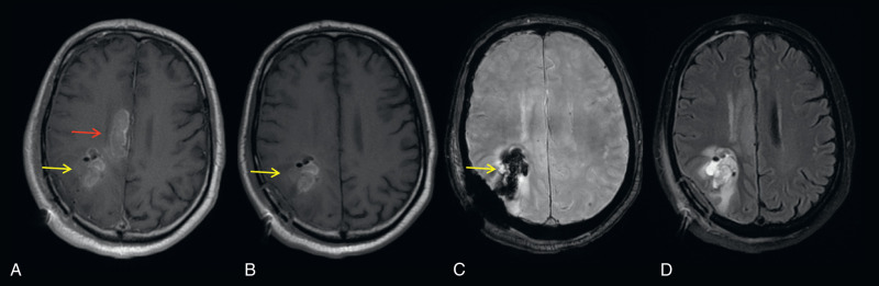 Figure 15.3, A 71-year-old man with newly diagnosed glioblastoma multiforme (IDH wild-type, methylguanine methyltransferase unmethylated) who underwent subtotal resection. Initial postoperative imaging with axial postcontrast and precontrast T1-weighted, SWAN, and FLAIR (A–D) images of the brain demonstrate two apparent lesions (A; red and yellow arrows ) within the right cingulate gyrus and right corona radiata on the postcontrast T1W images. The precontrast T1W image shows that the lesion within the right corona radiate (yellow arrow) is intrinsically T1 hyperintense (B) without significant enhancement, consistent with blood products as confirmed on the SWAN image (C).