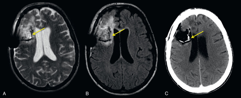 Figure 15.5, Gliadel wafers (arrows) in a patient with glioblastoma multiforme. Axial T2W (A), T2-FLAIR (B), and noncontrast CT (C) show Gliadel wafers within the right frontal resection site.