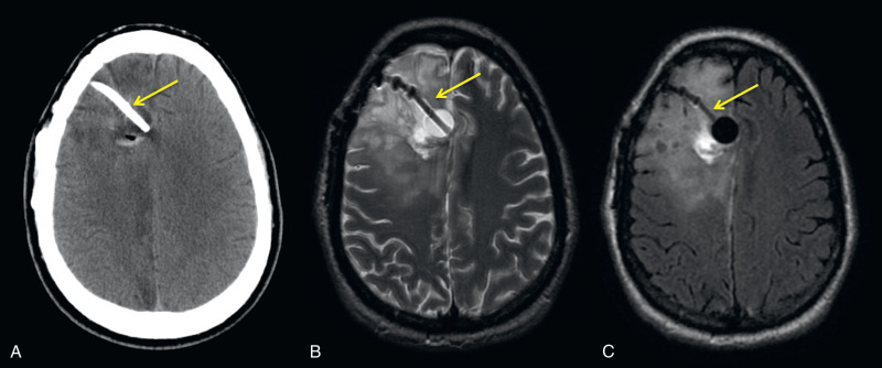 Figure 15.6, GliaSite radiation therapy system for treatment of a right frontal anasplastic astrocytoma. Axial CT (A), T2W (B), and T2-FLAIR (C) images show the GliaSite inflatable balloon catheter (arrows) within the right frontal surgical resection cavity.