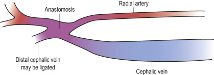 Fig. 50.1, Brescia–Cimino fistula (distal radial artery to cephalic vein).