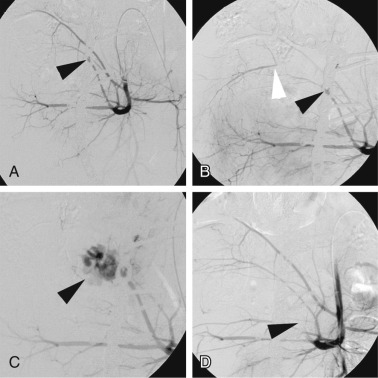 Fig. 49.1, Pelvic fracture post-internal fixation.