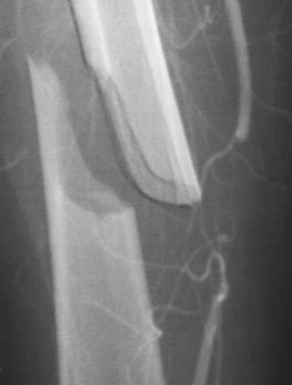Fig. 49.2, Acute occlusion of the superficial femoral artery secondary to femoral fracture.